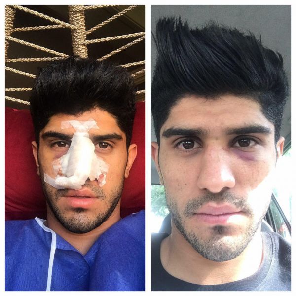 هافبک ذوب آهن پس از عمل جراحی عکس