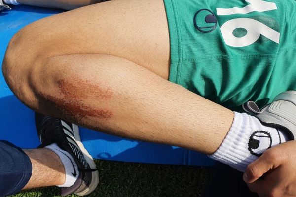 مصائب بازی روی چمن مصنوعی در تاجیکستان؛ زخمهای سطحی دردناک روی پاهای بازیکنان تیم امید ایران تصاویر