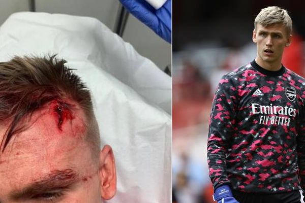 عکس؛ مصدومیت دروازهبان قرضی آرسنال از ناحیه سر