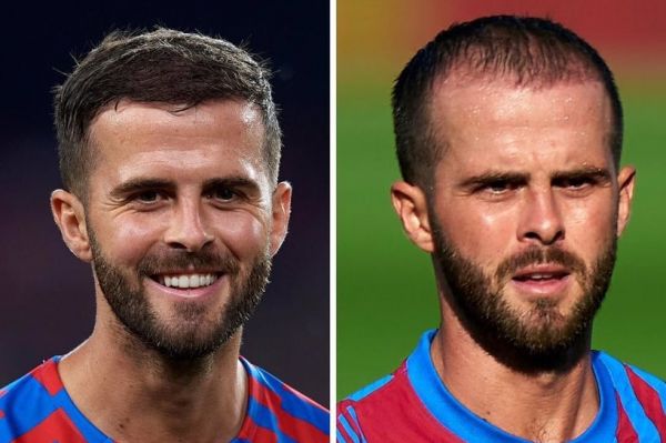  بازیکن بارسلونا و کاشت مو در کلینیک کریستیانو رونالدو