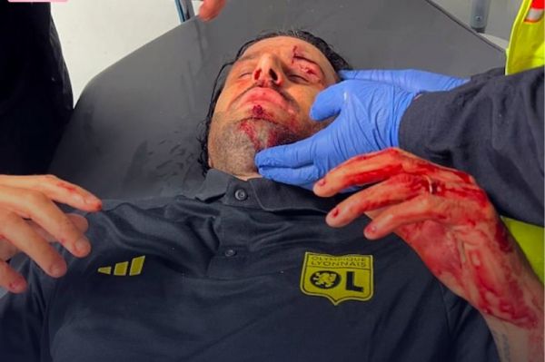  پرتاب سنگ پیش از بازی مارسی و لیون و مصدمیت  شدید فابیو گروسو