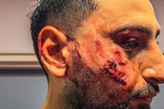 مصدومیت جدی ستاره ایتالیایی پاری سن ژرمن در جریان بازی با موناکو ویدیو