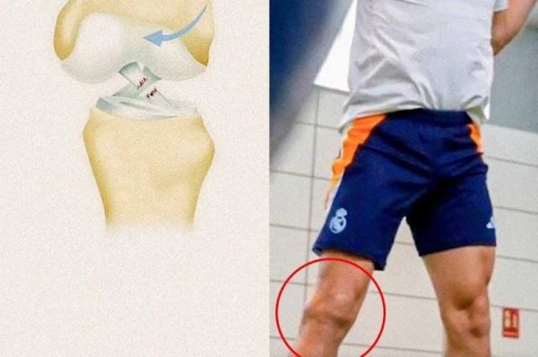  عکس؛ وضعیت زانوی کارواخال، پنج ماه پس از عمل جراحی