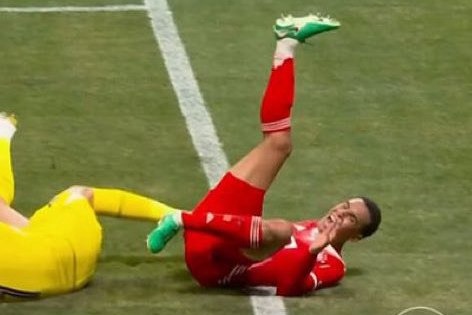  شوک در اردوی بایرن‌مونیخ؛ مچ پای چپ جمال موسیالا وحشتناک شکست