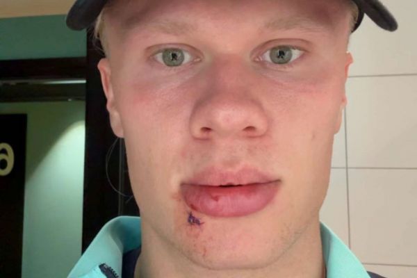 وضعیت ناجور هالند در نروژ 3 تا بخیه خوردم